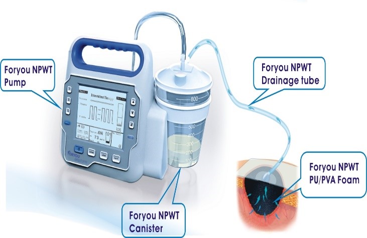 Foryou Npwt /negative Pressure Wound Treatment - Image 7